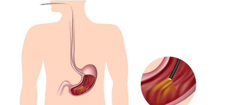 Endoscopic Procedures in Hyderabad