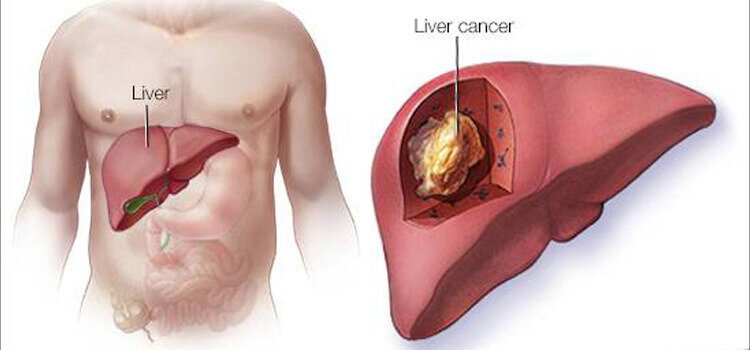 Best Treatment in Hyderabad for Liver Problems