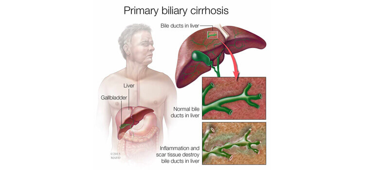 Gall Bladder Cancer Treatment